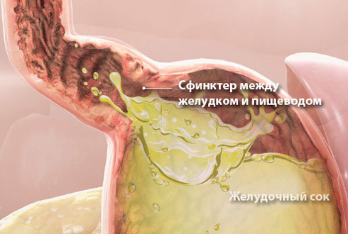 Изжога и её причины Изжога и её причины