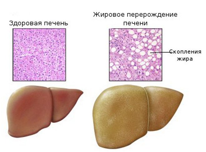 Жировая болезнь печени: что это и как себя уберечь? Жировая болезнь печени: что это и как себя уберечь?