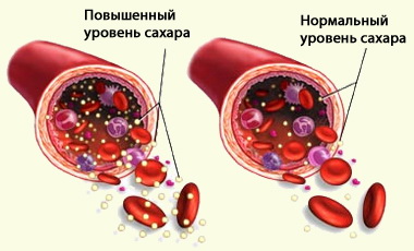 Какие бывают осложнения при диабете Какие бывают осложнения при диабете