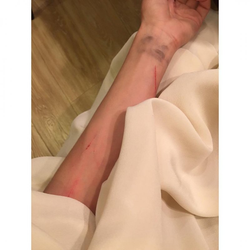 Кристина Асмус показала травмы после спектакля Кристина Асмус показала травмы после спектакля